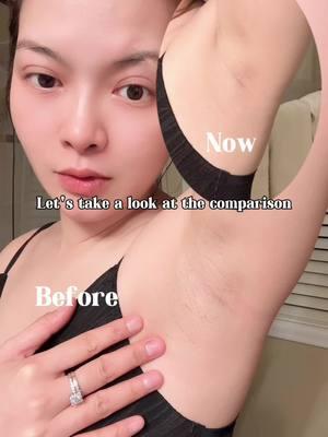 Ulike painless hair removal is so comfortable #ulikehairremoval#ulikeair10#laserhairremoval#ingrownhair#waxburns#shavinghacks#permanenthairreduction#nopainhairremoval  