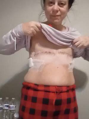 officially ten days post op. double mastectomy. #healing #HealingJourney #major #surgery #amputation #awareness #❤️ #contentcreator #fyp #fypシ #fypシ゚viral #foryoupage #viralvideo #viraltiktok #surgerytiktok #recovery #ouch #painful #😩 #🙄 #😬 #😭😭😭 