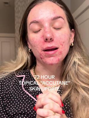 DAY 3 POST AEROLASE LASER UPDATE ON CYSTIC ACNE SKIN #acne #acneskin #acnetreatment #acnelaser #aerolase #facelaser #pcos #pcostreatment #unwantedhair #laserhair #laserhairremoval #pcosproblems #accutane #acnescars