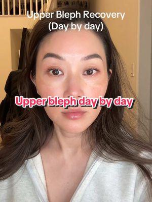 4 weeks of healing after my upper blepharoplasty.  Slow but steady.   #asiandoubleeyelid #upperblepharopasty #healingprocess #daybyday #upperbleph #blepharoplasty 