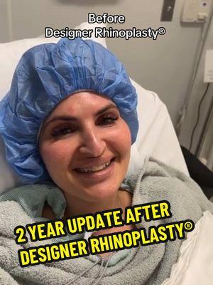 How amazing does our beautiful patient @Injectorjess PDO Queen look 2 years after Designer Rhinoplasty® 😍 “Out and about on 5th avenue 1 day post sinus surgery and rhinoplasty. What else would a NYC girl do After years of filler and PDO threads to help my downturn of my nose and bump I decided at 40 to get a more permanent solution. I loved having the ability to do non surgical options for years and see how my rhinoplasty would look. For many to its more cost effective till they can save up. I also had a lot of sinus pressure and congestion that ultimately would be helped by fixing my deviated septum. Thank vou to Dr. Kassir and your wonderful team. You listened to all my concerns and made me feel so comfortable. Even as a medical professional it’s hard to find such caring and artistic providers!” CLOSED, atraumatic technique ✨ ➡️ Bump removed  ➡️ Tip lifted & de-projected  ➡️ Profile straightened  ➡️ More aesthetic & feminine  ✅ No breaking of bones  ✅ No hammers or chisels  ✅ No packing ✅ No pain meds ✅ Minimal to no bruising  What do you guys think about her transformation? 🤔 Let us know in the comments 😊  ☎️ 212-288-3000 💌 DM us 📲 WhatsApp: 201-875-8482 Locations: 📍65 East 66th Street, New York, NY 10065 📍81 North Maple Avenue, Ridgewood, NJ 07450 #bestplasticsurgeon #topplasticsurgeon #newyorkplasticsurgeon #rhinoplastyny #rhinoplastynj #cutenose #bestrhinoplasty #dubai #rhinoplastyrecovery #newjersey #rhinoplastyspecialist  Disclaimer: I do not own or claim to own the audio in this video. All rights and permissions are granted to the owner of this sound.