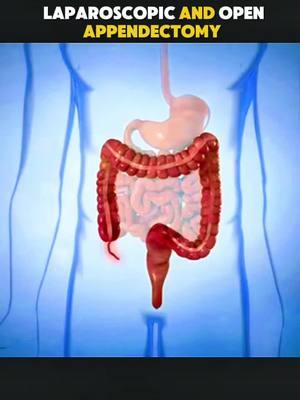 Laparoscopic and open appendectomy surgery, medical animation 3D ##appendectomy##appendixremoval##appendixsurgery##appendicitis##laparoscopicsurgery##laparoscopicappendectomy##medicalanimation