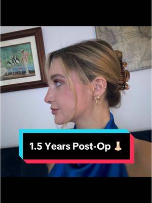 My beautiful patient 1.5 years post-op #rhinoplasty #rhinoplastynyc #nosejob #nosejobcheck #rhinoplastyspecialist #fyp  Every surgery has risks and you should be evaluated by a board-certified plastic surgeon to discuss all possible risks of surgery prior to undergoing any procedure.  