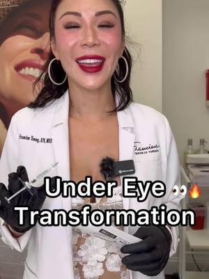 Bright Eyes, Refreshed Look! ✨ Let’s talk about subtle under-eye transformations. In this reel, I used a touch of filler to slightly volumize the hollow under the eye while enhancing overall skin quality. The goal? A refreshed, hydrated, and more youthful appearance—without over-volumizing. 💉 What we did: Carefully placed a small amount of filler to smooth the hollow under the eye. This adds just enough support to brighten and soften tired-looking eyes. Used filler with hydrating properties to biologically boost the skin, improving texture and elasticity over time. ✨ Why subtle is key: The under-eye area is delicate, and overfilling can create an unnatural or puffy appearance. By using just the right amount, we achieve: ✅ Brighter, refreshed eyes. ✅ Improved skin quality and hydration. ✅ A natural, rested look without the “done” effect. 👁️ Who is this for? If you’re noticing under-eye hollows or tiredness that no amount of sleep seems to fix, this treatment might be right for you! 💡 Pro Tip: Combining this treatment with good skincare and lifestyle habits can maximize and prolong your results. Curious about how we can enhance your under-eye area? Drop your questions below 💬 or DM me for a consultation. Let’s brighten up your look—subtly and beautifully! #UnderEyeTransformation #SubtleEnhancements #BiologicalHydration #YouthfulEyes #NaturalResults #SkinBoostingFiller #BrightAndRefreshed #AestheticMedicine #YKAdvancedAesthetics 