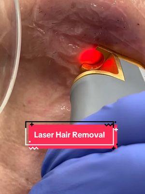 Laser hair removal is such a game changing treatment. However, it is importand to follow the pre and post instructions so get the best result! #lhr #laserhairremoval #laserhairreduction #yaglaser #drmara #dermatologist 