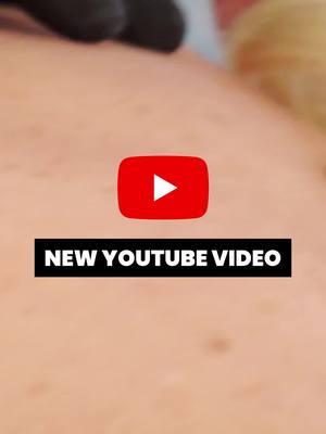 ⁣ ⁣ New YouTube joint just dropped …⁣ ⁣ #pimplepopper #pimplepopping #youtube #youtuber #drmudgil #nycdermatologist ⁣#thedoc #thedoctok ⁣ ⁣ ⁣ ⁣ ⁣ ⁣ ⁣ ⁣ ⁣ ⁣