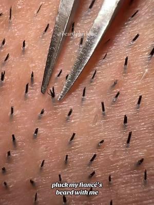 pluck my fiancé’s thick beard hairs with me 🥰  #plucking #satisfyingvideo #trichotillomania #satisfying #tweezing #fypage #skinpicking #ingrown 