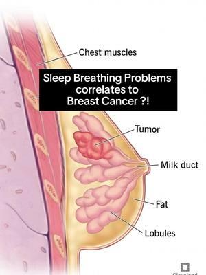 This Sleep Connection is Eye Opening. 🤯 History of breast cancer in your family can increase the chances of this for you if sleep deprivation occurs nightly. The immune system regenerates nightly. This deep sleep time allows the production of antibodies that boost and regenerate the immune, fights inflammation and washes out the toxins accumulated from the brain out. Please try to sleep well. Sleep Helps Healing. #goodnight #sleeptight #rest #immunesystem #takecareofyourself #sleepstudy #sleepdentistry #nap #BreastCancerAwareness #sleep #obstructivesleepapnea #sleepapnea #nosebreathing #miamidentist#drnassery