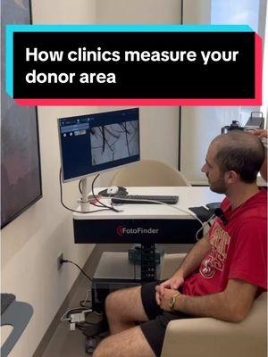 How clinics measure your donor area when getting a hair transplant #hair #hairloss #hairgrowth #hairprogress #haircare #hairline #recededhairline #regrowth #bald #balding #thinning #thinhair #thick #full #products #medication #treatment #finasteride #minoxidil #scalpmassager #rosemaryoil #dermaroller #xyon #xyonpartner #growplex #aimike #rogaine #keeps #hims #propecia #kirkland #topical #foam #liquid #oral #pill #journey #transformation #daily #series #day120 #tutorial #stepbystep #routine #regimen #results #proof #beforeandafter #slowlybutsurely #trusttheprocess #followalong #explanation #education #explained #DHT #hairfollicles #baldspot #howto #consistency #everyday #nevergiveup #positivity #motivation #hairtok #fyp #viral #xybca #chris #zeph #ibby #freddy #turkey #vitamins #biotin #hairtransplant #grafts #donorarea #complex10 #suppliment #prescription #hairfibers #hairfiller #fibers #veraclinic #mane #maneexlirblend #maneoils #maneoilblend #price #turkey #istanbul #medicatedlotion #lightlytap 