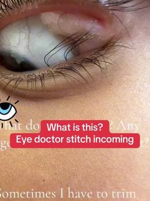 #stitch with @JoVee Shasti #dermoidcyst #dermoid #ophthalmology #ophthalmologist #eyedoctor #eyesurgeon