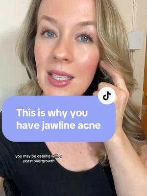 This is why - what Qs do you have for me?! #jawlineacne #hormonalacne #clearacnenaturally #healingacnenaturally #hormoneimbalancetips #fungalacneskincare #clearskintip #hormoneimbalanceproblems #foodforacne #clearskintip #hormoneimbalanceproblems #onthisday #hormonalacnejourney #postpillacne #clearskin #clearskinroutine 