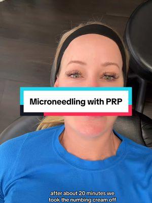 Vampire Facial #microneedlingface #microneedling #facial #prp #skincare #matureskin #over40 #prp #dermapen #dermatology #skin #skincareroutine #skincaretips #SkinCare101 