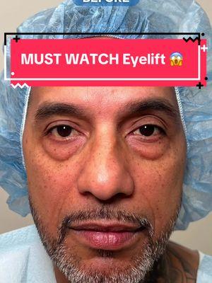 A Patient’s Journey: Lower Blepharoplasty with Fat Transfer 👀 ❓Many of you have been curious about this patient’s progress since we last shared his immediate post-op results. Here’s an update showing how beautifully he’s healed after undergoing lower blepharoplasty with fat transfer! 👤This patient, like so many others, took his time deciding to move forward with surgery. We’re honored that he not only trusted us with his care but also graciously allowed us to share his transformative journey. His experience is a reminder that taking that step toward self-confidence can be life-changing. More healing to go. Stay tuned!  🎁 Thinking about a holiday refresh? Just imagine your “bags” packed and under the tree this year! 🩺 @drhdoshi 🩺 @drhdoshi #blepharoplasty #DrDoshi #eyelift #fattransfer #nycplasticsurgeon