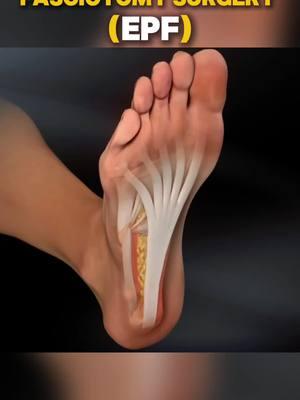 Say Goodbye to HEAL Pain Forever with EPF procedure( Endoscopic Plantar Fasciotomy Surgery) #healpain  #heel  #heels  #pain #epf  #endoscopic #plantar #footsurgery #fasciotomysurgery #fasciotomy 