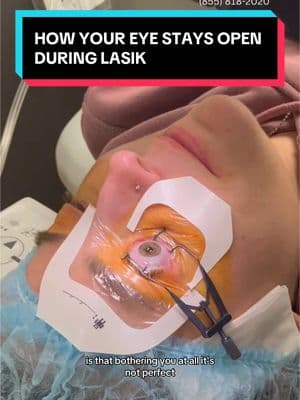 How your eye stays open during LASIK #lasik #lasikeyesurgery #vision #laser #visioncorrection #eyesurgery #eyes #eyesurgeon #ophthalmology #ophthalmologist #glasses #fyp #foryou #foryoupage #beverlyhills 