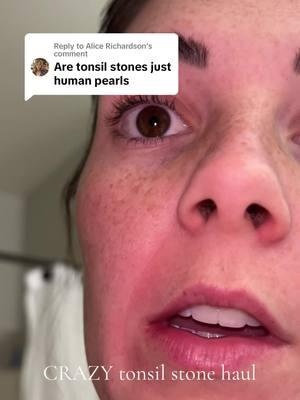 Replying to @Alice Richardson  this was WILD #tonsilstones #tonsils #zits #pickers 