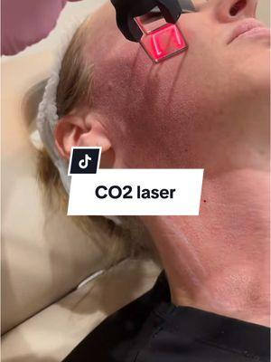 One of my fav skin treatments #co2 #co2laser #onthisday 