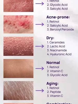 Skin Type and Treatment! #SkincareRoutine #HealthySkin #GlowingSkin #SkinCareTips #SkinLove #NaturalSkincare #SkincareCommunity #SkinCareAddict #BeautyCare #SkincareLover #SelfCareRoutine #FlawlessSkin #RadiantSkin #SkinCareProducts #SkincareJunkie #SkinHealth #HydratedSkin #GlowUp #SkincareEssentials #SkincareGoals