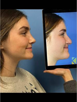 #orlandofacialplastics #facialplasticsurgery #rhinoplasty #nosejob #scarlessrhinoplasty #surgeonsoftiktok #fyp #transformation 