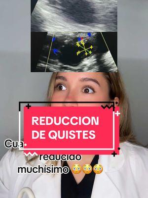 QUISTES QUE MEJORAN CON TRATAMIENTO GRACIAS QUERIDAS PACIENTES #viral_video #embarazo #quistes #hormonal #insulina #resistenciaainsulina 