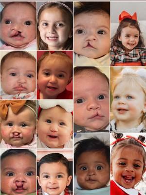 Happy Holidays❤️❄️☃️, everyone!! Thank you to all the parents who shared these adorable  🥰 holiday photos of their #cleftcuties! #TeamRAR enjoyed them all!  Keep the photos coming, parents! We will share more tomorrow! 🎄  These images are the property of Dr. Rachel A. Ruotolo and NYPSG and are not authorized for use by any other party. This is my actual patient with real results who has given informed consent (directly or indirectly via parents) to appear on my website and social media pages. #cleftlip #cleft #cleftbaby #cleftliprepair #pediatricplasticsurgeon #nyc #babylon #gardencity #holiday #celebrate #Love #holidaycard #christmascard #christmastime