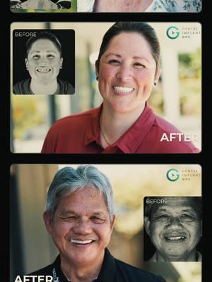 Check out these stunning before & after photos of our Dental Implants GPS patients! #DentalImplants #BeforeAndAfter #SmileTransformation #GPSDentistry #PatientJourney #OralHealth #ConfidenceBoost #DentistryLife #TeethTransformation #HealthySmile #DentalCare #SmileMakeover #AestheticDentistry #RestorativeDentistry #BeautifulSmiles #OralRehabilitation #DentistApproved #HappyPatients #TeethGoals #TransformationTuesday #InspireConfidence #DentalSuccessStories #SmileBrighter #LifeChangingDentistry #PatientTestimonials #NewBeginnings #DentalWellness #BeforeAndAfterPhotos #SkillsShowcase #TransformYourSmile