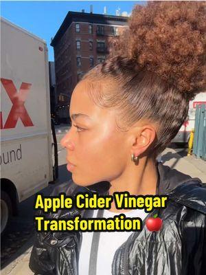 Tutorial pinned on my home page‼️ 4 years of using diluted ACV as a toner🫱🏽‍🫲🏻 one of my favorite hacks for getting rid for texture #acv #acne #breakouts #applecidervinegar #pimples 