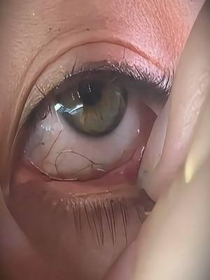 #eyecleaning #eyecleaningasmr #asmr #satisfying #eyemucous #fishingsyndrome #eyestringremoval #removal