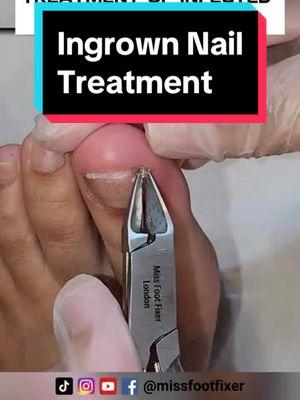 A SUPER SERIOUS INFECTED INGROWN TOENAIL EXTRACTION BY FOOT DOCTOR MISS FOOT FIXER #fungaltoenail #missfootfixer #fungaltoenailtreatment #fungaltoenailremoval 