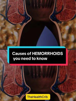 Causes of HEMORRHOIDS you need to know#hemorrhoid#hemorroides#hemorrhoidectomy 