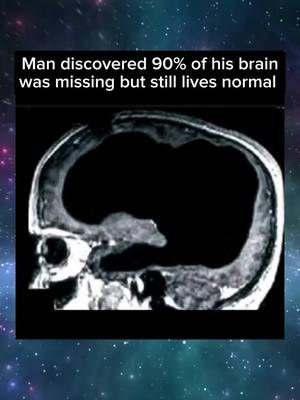 man missing 90 percent of his brain but atill has IQ of 84. the internet is connected by hundreds of undersea fiber optic cables. The human face develops in 9 months from embryo.  #thebrain  #discovery #alfredthealien #lastmemeof2024 #alien #lockedin #geeked 