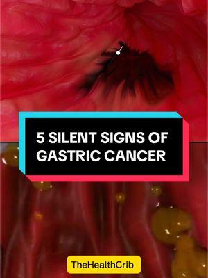 Silent signs of gastric cancer #gastriccancer#gastriccancerawareness#stomachcancerawareness#stomachproblems 