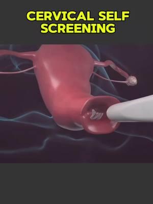 Cervical Self Screening  #CervicalScreening #SelfScreening #HealthAwareness #PreventCancer #StayHealthy #WomenHealth #EarlyDetection #ScreeningSavesLives #CervicalCheck #TakeControl