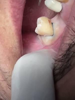 Retraction cord #dentist #dental #dentistry 