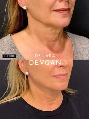 Facelift and necklift progression: before, 1 week after, and 3 months after surgery for my beautiful patient. Here I performed midface lift, lower facelift, neck lift, autologous fat grafting, and erbium laser resurfacing for a global surgical facial optimization that provide provides an understated and elegant outcome. #beautyisinthedetails #devganoptimization #facialoptimization #boardcertifiedplasticsurgeon 