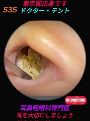 relax with me #earwaxremoval #ear #earwax #cleaning #relax #satisfy 