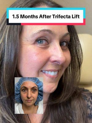 Trifecta Lift = lower blepharoplasty + fat transfer to mid-face + skin tightening. 📍Beverly Hills, CA  #eyes #eyebags #eyemakeup #puffyeyes #blepharoplasty #bleph #kamiparsamd 