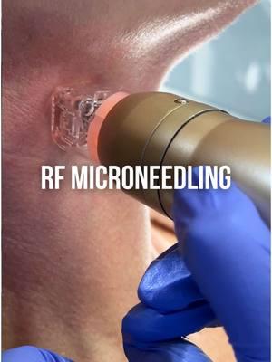 RF Microneedling is here! 💉 We’re excited to offer this procedure for our patients!  Call (949) 200-1591 to schedule an appointment with us! 🤩 #appearancecenter #newportbeach #rfmicroneedling #microneedling #skintreatment #skinhealth #orangecounty #winterskincare #winterskincareroutine #sylfirmx #acnescars #acnescartreatment #acnescarring #poreminimizer #poreminimizing #acne #radiofrequencymicroneedling 