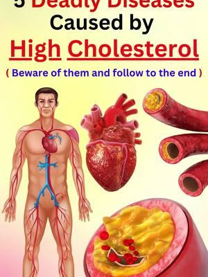 5 deadly diseases caused by high cholesterol  Beware of them and follow them until the end. #cholesterol #diseases  #Type2diabetes  #diabetes  #highcholesterol  #insulin  #Atherosclerosis #arteries #bloodflow  #Stroke #heartattack #brain #Highbloodpressure #bloodpressure #stress  #heart #bloodvessels #Liver #Liverdisease  #pancreatitis #liverfunction #triglyceride  #fattyliver  #comments #diseases   #Save  #share  #family  #friends  #health  #wellness