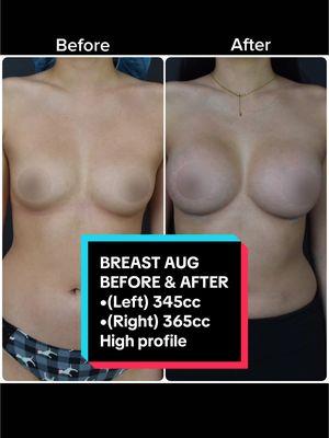 5 months post breast augmentation ✨ My patient has a 345cc high profile Natrelle implant on the left breast and a 365cc high profile implant on the right. #breastaugmentation #breastaug #beforeandafter 