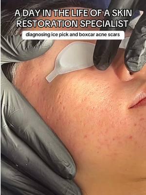 Acne can leave a variety of different types of scars. My patient here has a combination of ice pick and boxcar scars. Here you can watch me diagnose these scars and prepare a custom treatment plan for them. Let’s breakdown the types of scars: Ice pick scars are those deep, narrow pitted scars that can resemble, well, ice pick holes! They occur when there's significant inflammation deep within the skin. Boxcar scars have sharper edges and a wider, more rectangular shape, almost like little boxcars indented in the skin. These form when there's significant collagen loss in the deeper layers of the skin. Now, let's talk about the redness you might be seeing. Sometimes, post-inflammatory hyperpigmentation (PIH) can linger after acne has cleared. This redness is caused by an overproduction of melanin, the pigment in our skin. It can be mistaken for active acne which we were able to normalize for our patient with our active acne laser treatment. Want to see more of this patient’s journey - comment below. Ready to book a consultation? Comment "Qazi" below to set up your consultation and let’s build a plan to transform your skin. Got questions about this process, your skincare or treatment options? Join me live Monday through Thursday at 9 PM PST on TikTok, Instagram, YouTube, and Twitch. I’ll be answering your questions, giving honest, unsponsored advice, and sharing recent results.   Self-book your consultation today at doctorqazi.com Call/text: 949-336-7293 Whatsapp: +1 (714)-860-6945 20271 SW Birch St Suite 100, Newport Beach, CA 92660   #acnescars #acnescartreatment #acnescar #icepickscar #boxcarscar #rollingscar #subcision #taylorliberatorsubcision #acne #doctorqazi #qazicosmeticcenter #dayinthelife #doctorvlog #NewportBeach #co2laser #ablativeco2laser 