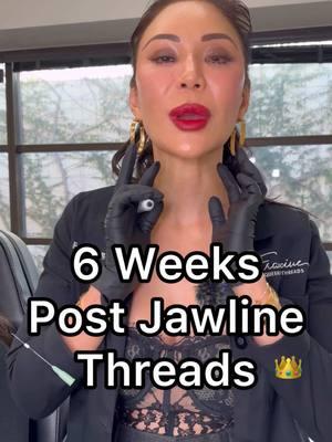 6 Weeks Post-PDO Threads: Why Results Only Get Better with Time ✨ Here’s a close-up of my long-term patient’s snatched jawline—and this is just the beginning. These stunning, settled results are 6 weeks post PDO threads, showing how powerful threads are when combined with a personalized treatment plan over time. 💡 How do PDO threads work? 1️⃣ Immediate Lift: Right after the procedure, you’ll see an instant lift thanks to the mechanical action of the threads. 2️⃣ Collagen Stimulation: Over the next 6–12 weeks, the threads stimulate your body’s natural collagen production, tightening and firming the skin. 3️⃣ Long-Term Improvement: As collagen continues to build, the results become more refined and natural, giving you an even more defined and youthful look with time. ✨ Why these results shine: This patient’s jawline transformation isn’t just about PDO threads. Her results are the culmination of filler, neurotoxin, and PDO threads, used over time to address her unique needs and enhance her natural beauty. ➡️ Neurotoxin helps slim and shape the jawline while prolonging the results of PDO threads. ➡️ Filler restores lost volume and improves skin texture, complementing the lifting and tightening effects of the threads. 💬 Aesthetic medicine is not a one-size-fits-all solution. It’s a journey of combining treatments tailored to your facial structure, goals, and natural aging process. 👩‍⚕️ Ready to start YOUR journey to a more lifted, defined, and youthful look? DM me or drop your questions below! 📅 Remember, your best results come with time, consistency, and a comprehensive approach. Let’s create a plan that works for YOU! #PDOThreads #SnatchedJawline #6WeekResults #NaturalLift #CollagenBoost #FacialRejuvenation #CombinationTherapy 