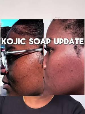 Kojic Soap Update! 🧼🫧 I use this Kojic Soap if not everyday . Definitely made a difference for me #creatorsearchinsights #kojicsoapreview #kojicsoap #skincareroutine #skincaretips #akincaretiktok #skincaretiktok #skincareasmr #skincarehacks #akincaretiktok 