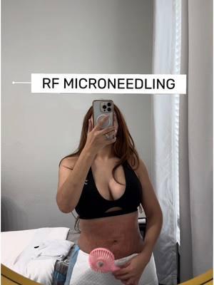 Helping the appearance of my tummy with RF Microneedling!  Hears why I went this route: •Helps to reduce the appearance of stretch marks  •Treats Pigmentation  •Helps tighten and smooth out skin  I am fully aware that my mommy stretch marks are not going away but if I can help them get better it’s worth the try! This was my first session and can already tell the difference! I have 2 more sessions to go and I’ll be showing you the process along the way.  📍@Anna #rfmicroneedling #microneedling #microneedlingtreatment #zeropain #reels #microneedlingrf #mommystretchmarks #stretchmark #stretchmarktreatment