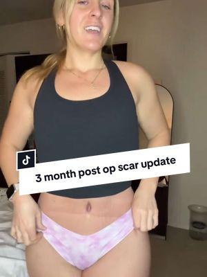 12 weeks post op scar update! #tummytuckjourney #tummytuckscars #tummytuckrecovery #tummytuckcheck #tummytuckresults #tummytuck 