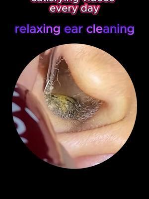 So satisfying 😍 #earwax #ear #earwaxremoval #satisfying #asmr #relax 