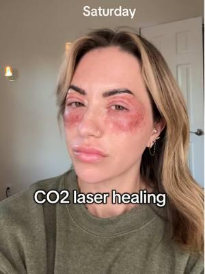 Almost a full week of healing from CO2 Dekka Eyes !! LMK if you have any other questions on the process - honestly way easier than I expected. #co2lasertreatment #co2laser #dekkaeyes #co2laserskinresurfacing 