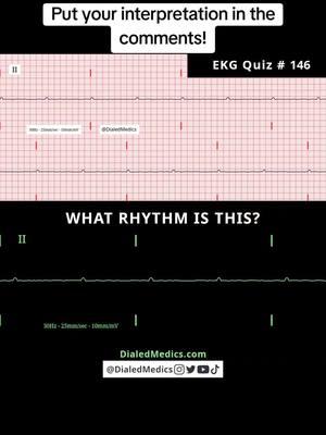 🛑🫀🤔 All #EKG recordings are from the EKG rhythm generator on my website (LII rhythms only for now, 12Ls are in beta and coming soon), be sure to check it out for more software generated #ECG practice! (Link in bio.) #EMS #ACLS #emstok #paramedic #paramedicsoftiktok #medic #medicsoftiktok #flightmedic #criticalcareparamedic #paramedicstudent #paramedicschool #emta #emtb #emt #emtlife #emtsoftiktok #emtstudent #emtschool #firstresponders #NREMT #nurse #nursesoftiktok #RN #nursingstudent #nursingschool #flightnurse #criticalcarenurse #emergencynurse #NCLEX #nclexrn #nclexprep #doctor #doctorsoftiktok #medicalstudent #USMLE #emergencymedicine #criticalcare #cardiology #FOAMED 