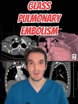 Truly the craziest interventional radiology case of a glass shard that had migrates into the pulmonary artery, causing essentially a glass pulmonary embolism. _________________________________ #medicine #doctor #doctors #radiology #radiologist #radiologia #doctorsoftiktok #medstudent #medicalstudent #medschool #medicalschool #medtok #doctorlife #tiktokdoc #tiktokdoctors #SiemensHealthineers #butterflyIQ #tempusAI #radAI #RadiologyReimagined #Stryker #Medtronic #AIDoc #Barcogram #hyperfine #bodyspec #prenuvo #ezrascan #DragonMedicalOne #MModal #abbottglobal #healthtech #emergency #emergencyroom #emergencymedicine  #neurology #pediatrics #pediatrician #neurosurgery #ultrasound #ctscan #xray #mri #greenscreen 