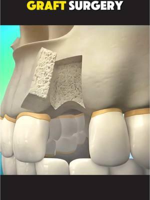 Dental Bone Graft Surgery (3D Animation)  #bonegrafting #dentalbonegraft #dentalbonegrafting #bonegraftsurgery #dentalimplants #dentalimplantsurgery #dentalimplant #medical3danimation #3dmedicalanimation #toothimplant #teethimplants 